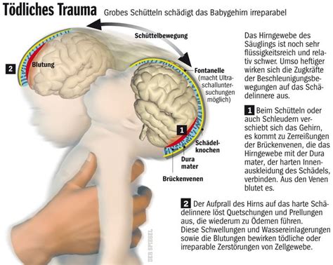 Illustration, die die Kräfte beim Schütteln eines Babys und die daraus resultierenden Hirnschäden darstellt.
