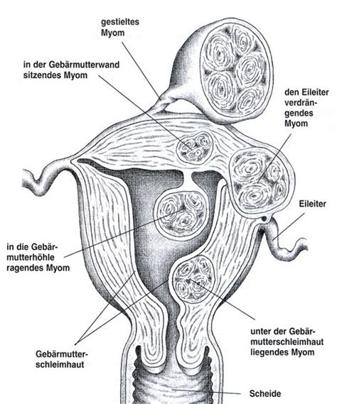 Darstellung einer Gebärmutter mit Myomen