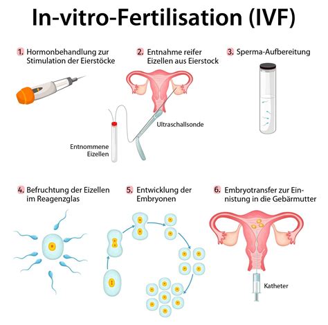 Schema des IVF-Prozesses: Stimulation der Eierstöcke, Eizellentnahme, Befruchtung im Labor, Embryokultur und Embryotransfer in die Gebärmutter.