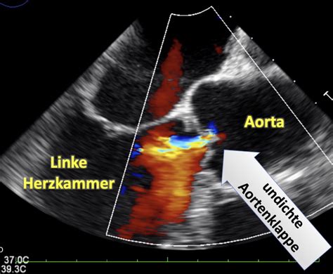 Darstellung einer transösophagealen Echokardiographie