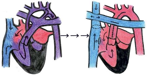 Infografik, die die Überlebensraten von Kindern mit angeborenen Herzfehlern über die Jahrzehnte vergleicht