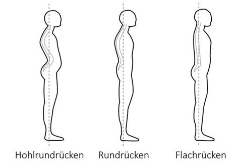 Grafische Darstellung der verschiedenen Wirbelsäulenformen: Hohlkreuz, Rundrücken, Hohlrundrücken und Flachrücken.