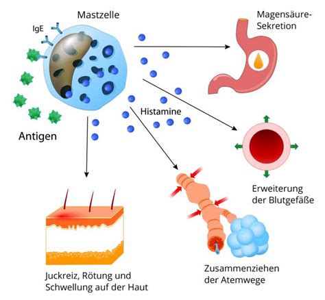 Schema der Histamin-Ausschüttung bei Nesselsucht