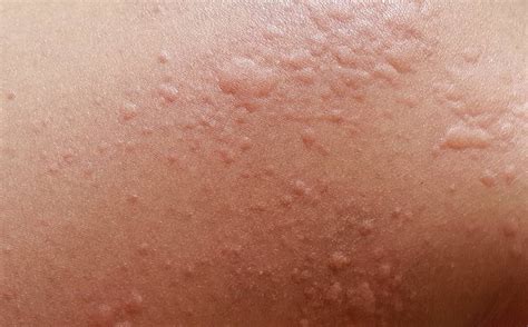 Urtikaria-Ausschlag am Bauch durch Impfreaktion: Mehrere unterschiedlich große und teils miteinander verschmolzene Quaddeln, flach erhaben, gerötet und stellenweise von einem weißen Rand umgeben.