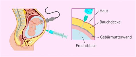 Grafik, die den Ablauf der Amniozentese zeigt
