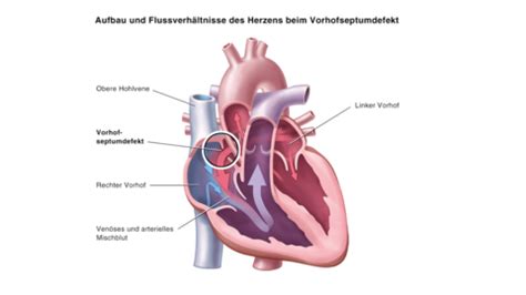 Schema eines Herzens mit einem Vorhofseptumdefekt, das den Blutfluss illustriert