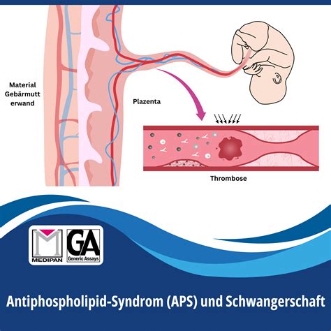Schematische Darstellung des Antiphospholipid-Syndroms und seiner Auswirkungen auf die Schwangerschaft