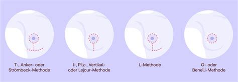 Schema einer Brustverkleinerung mit Darstellung der Schnittführung und Gewebeentfernung