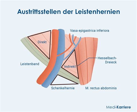 Illustration einer eingeklemmten Leistenhernie mit roter, fester Schwellung