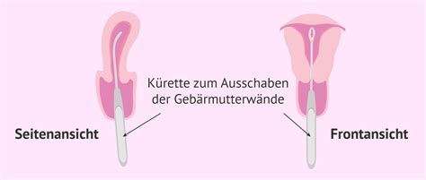 Schema: Ablauf einer Kürettage