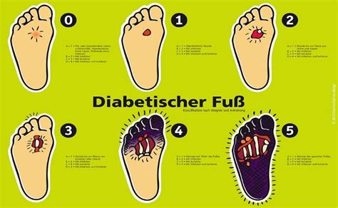 Illustration des diabetischen Fußsyndroms und seiner Behandlungsschritte
