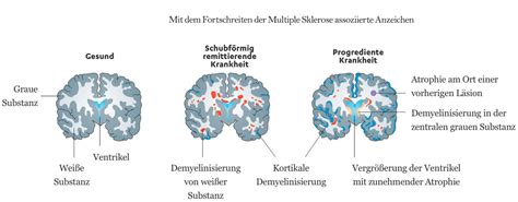 Grafik, die den Verlauf einer schubförmig remittierenden Multiplen Sklerose mit Schüben und Remissionen darstellt