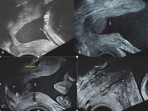 Schema der Messung der Zervixlänge mittels transvaginalem Ultraschall
