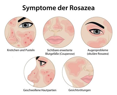 Schema der Rosacea-Typen und deren Symptome