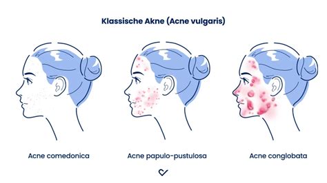 Vergleich von Akne-Läsionen