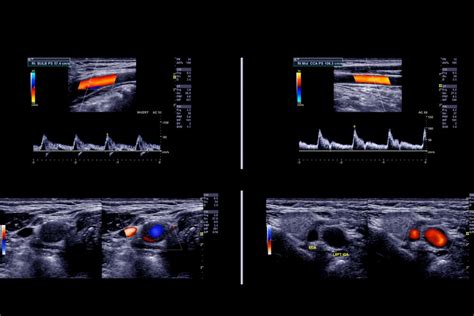 Darstellung einer transvaginalen Sonographie mit Farbdoppler, die das Blut in den Gefäßen über dem Muttermund zeigt.