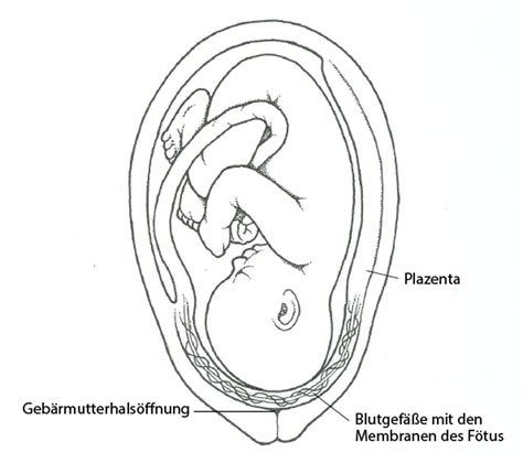 Schemavergleich: Vasa Praevia (Blutgefäße in Eihäuten über dem Muttermund) vs. Plazenta Praevia (Plazenta bedeckt den Muttermund).