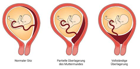 Schema einer Gebärmutter mit normaler Plazentalage und Plazenta praevia