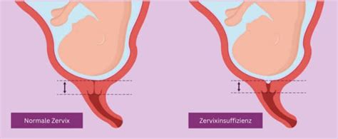 Grafik, die die verschiedenen Symptome einer Zervixinsuffizienz auflistet