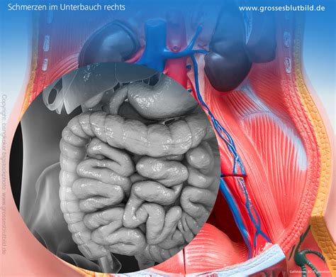 Illustration des chirurgischen Eingriffs eines Kaiserschnitts mit Schnittführung im Unterbauch.
