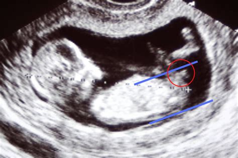 Ultraschallbild eines Fötus im ersten Trimester mit Markierung des Genitalhöckers (Nub) und der Wirbelsäule zur Veranschaulichung der Winkelmessung.