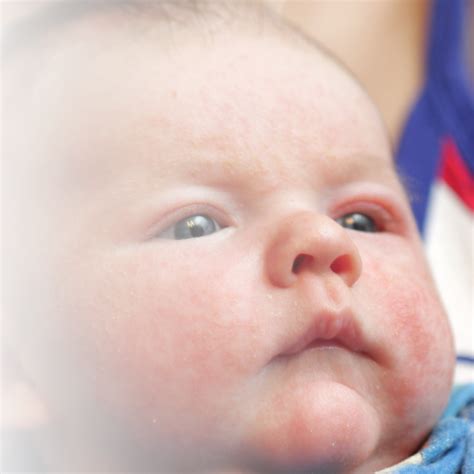 Gesicht eines Babys mit geröteten, schuppigen Hautstellen