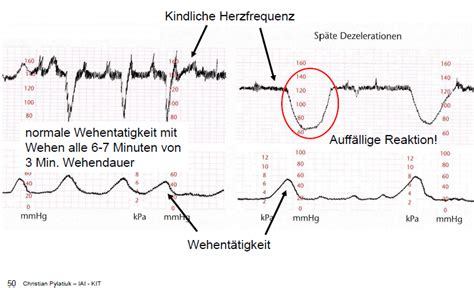 Beispiel einer CTG-Aufzeichnung mit fetaler Herzfrequenz und Wehentätigkeit