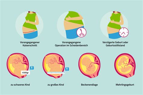 Infografik: Vergleich von natürlicher Geburt und Kaiserschnitt mit Fokus auf Mikrobiom-Transfer