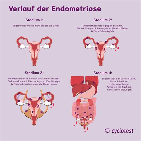 Schema, das die Unterschiede zwischen Mittelschmerz und anderen gynäkologischen Beschwerden wie Endometriose oder Zysten aufzeigt.