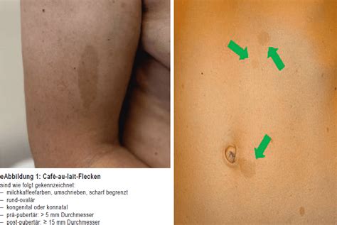 Beispiele für Café-au-lait-Flecken und Neurofibrome