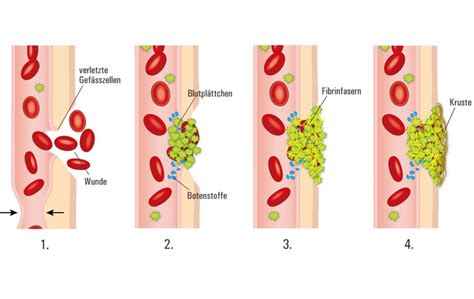 Schema, das verschiedene Ursachen für Blutverlust bei Neugeborenen darstellt