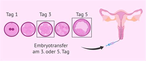 Grafik, die die Erfolgsraten bei Embryotransfers an Tag 3 und Tag 5 vergleicht