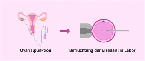 Illustration des Verfahrens der Eizellentnahme (Follikelpunktion)