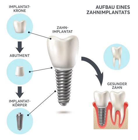 Schema eines Reisebetts mit seinen Hauptkomponenten