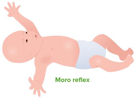 Schema des Moro-Reflexes mit den einzelnen Bewegungskomponenten