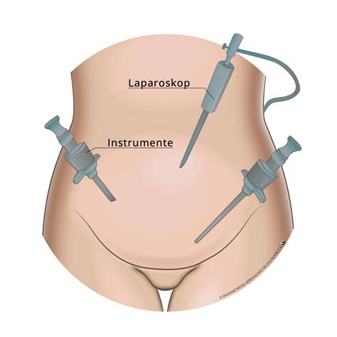 Schema der DaVinci-assistierten Laparoskopie zur Behandlung von Endometriose.