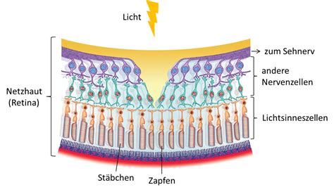 Schema eines retinalen Venenverschlusses mit Blutrückstau und möglichen Blutungen in der Netzhaut