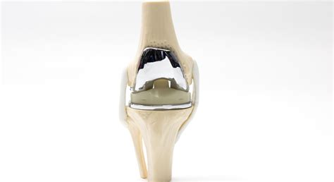 Schema des Aufbaus eines künstlichen Kniegelenks