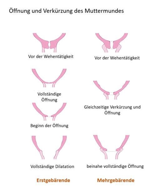 Schema der Muttermundöffnung während der Eröffnungsphase