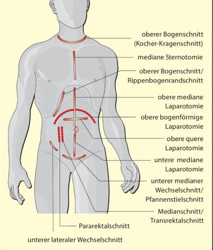 Vergleich von Bauchschnitt-OP und Schlüssellochchirurgie