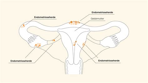 Schema, das die Ausbreitung von Endometrioseherden im Körper zeigt (z.B. Eierstöcke, Darm, Bauchfell).