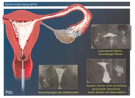 Schema der Eileiterdurchgängigkeitsprüfung mittels Ultraschall (HSSG)