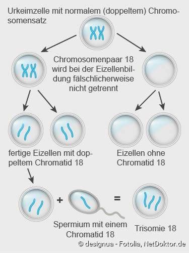 Schematische Darstellung des Chromosoms 18 mit einer zusätzlichen Kopie, die zu Trisomie 18 führt.