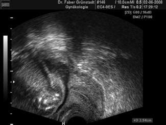 Grafik zur Messung der Gebärmutterhalslänge mittels Ultraschall