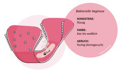 Mikroskopische Aufnahme von Bakterien, die eine bakterielle Vaginose verursachen