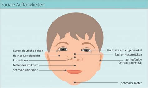 Fotocollage, die typische Gesichtsmerkmale von Kindern mit FAS zeigt (verkürzte Lidspalte, schmale Oberlippe, fehlendes Philtrum).