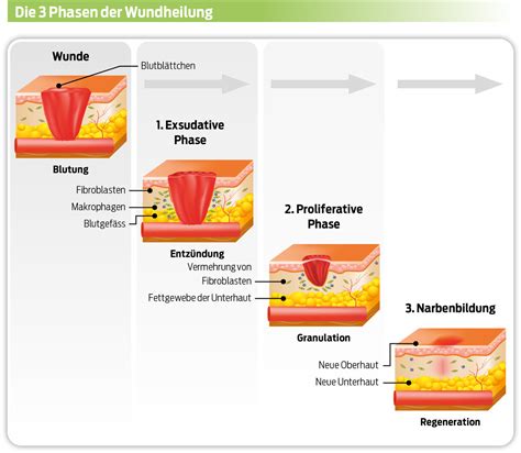 Schema der Wundheilungsphasen nach einem Kaiserschnitt