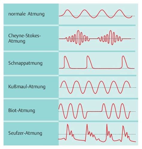 Diagramm: Normales Atemmuster vs. Apnoe bei Neugeborenen
