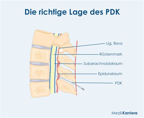 Illustration des Periduralraums und der Katheterplatzierung