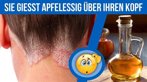 Infografik: Wie Apfelessig bei Pilzbefall der Kopfhaut hilft